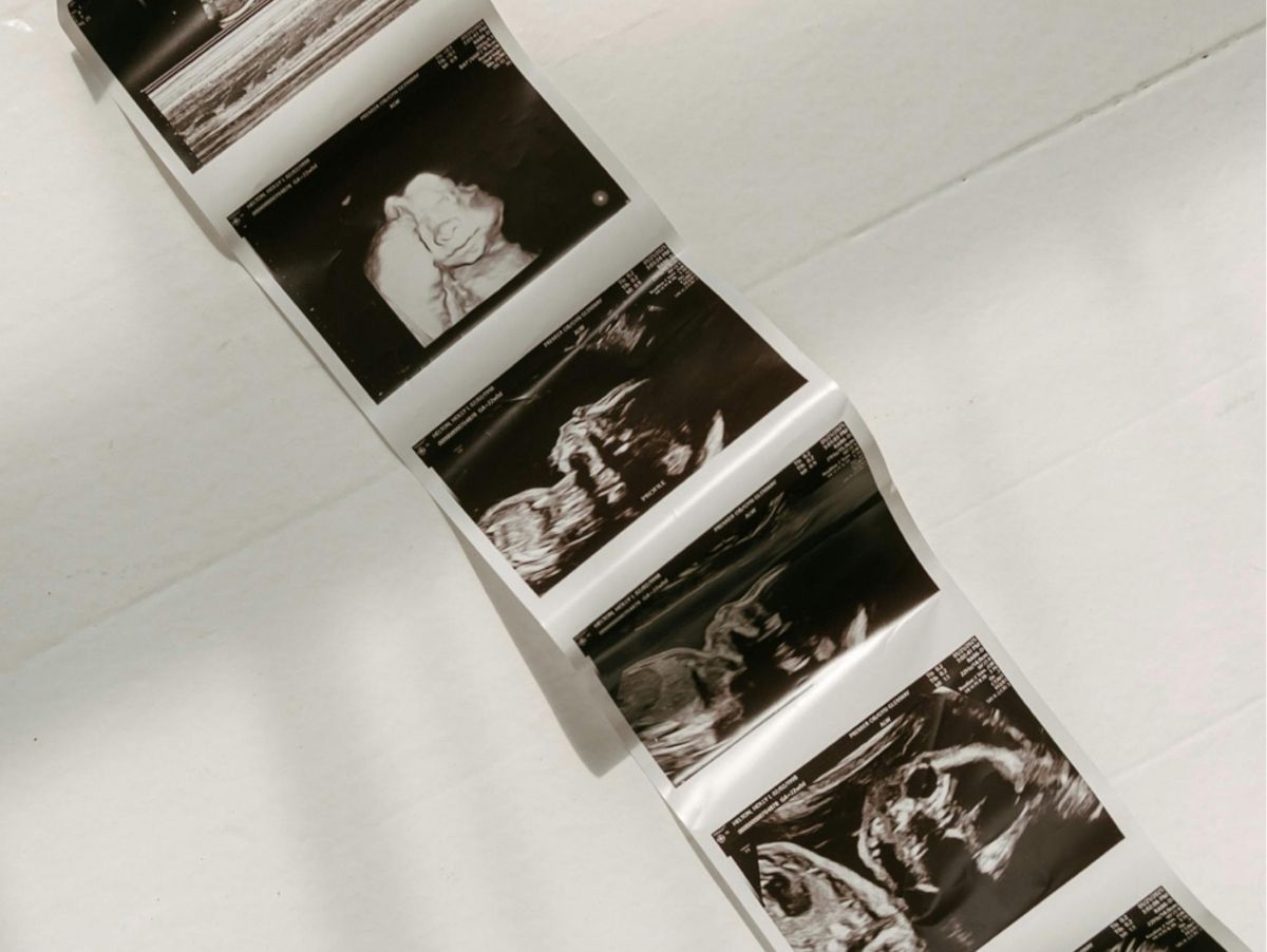 LMP vs Ultrasound Due Date: Why Might They Differ?